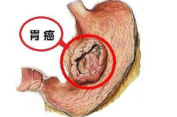 治疗胃癌,胃癌治疗策略与综合治疗方案